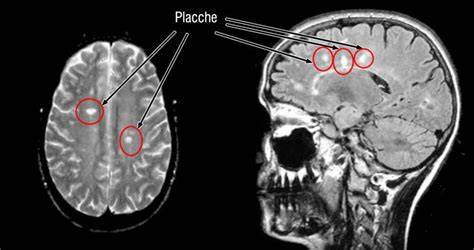 Illustrazione stilizzata del cervello con placche di sclerosi multipla
